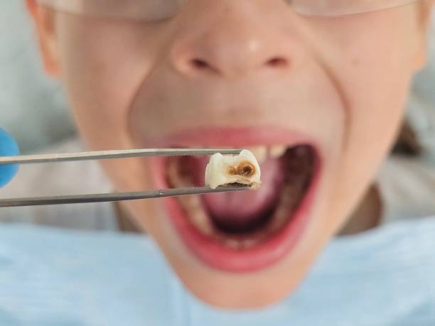 Best Urgent Care for Lost Fillings or Crowns in Aurora, TX