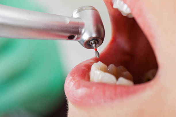 Best Emergency Dental Care for Broken or Chipped Teeth in Aurora, TX